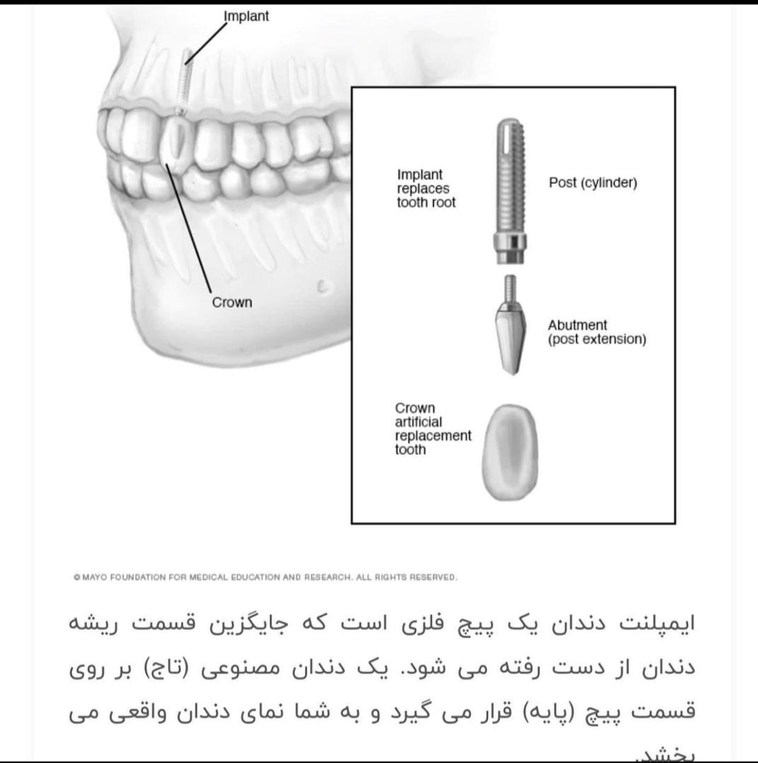 ایمپلنت